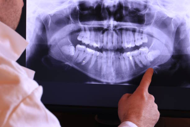 Best Emergency Wisdom Tooth Extraction in Staten Island, NY